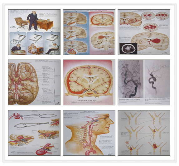 출혈성 뇌졸중 이미지