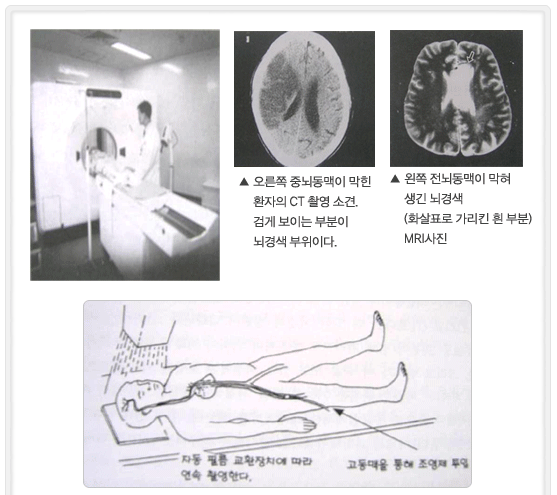 뇌졸중 발생조건 이미지01