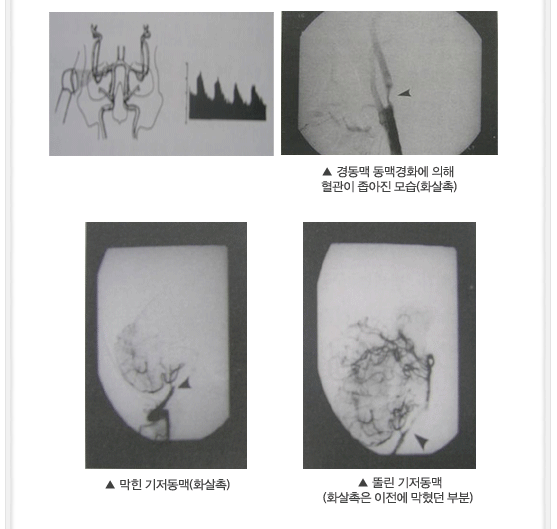 뇌졸중 발생조건 이미지02