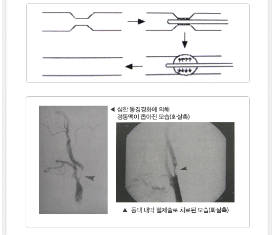 뇌졸중 발생조건 이미지03