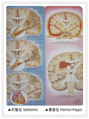 허혈성 뇌졸중 이미지